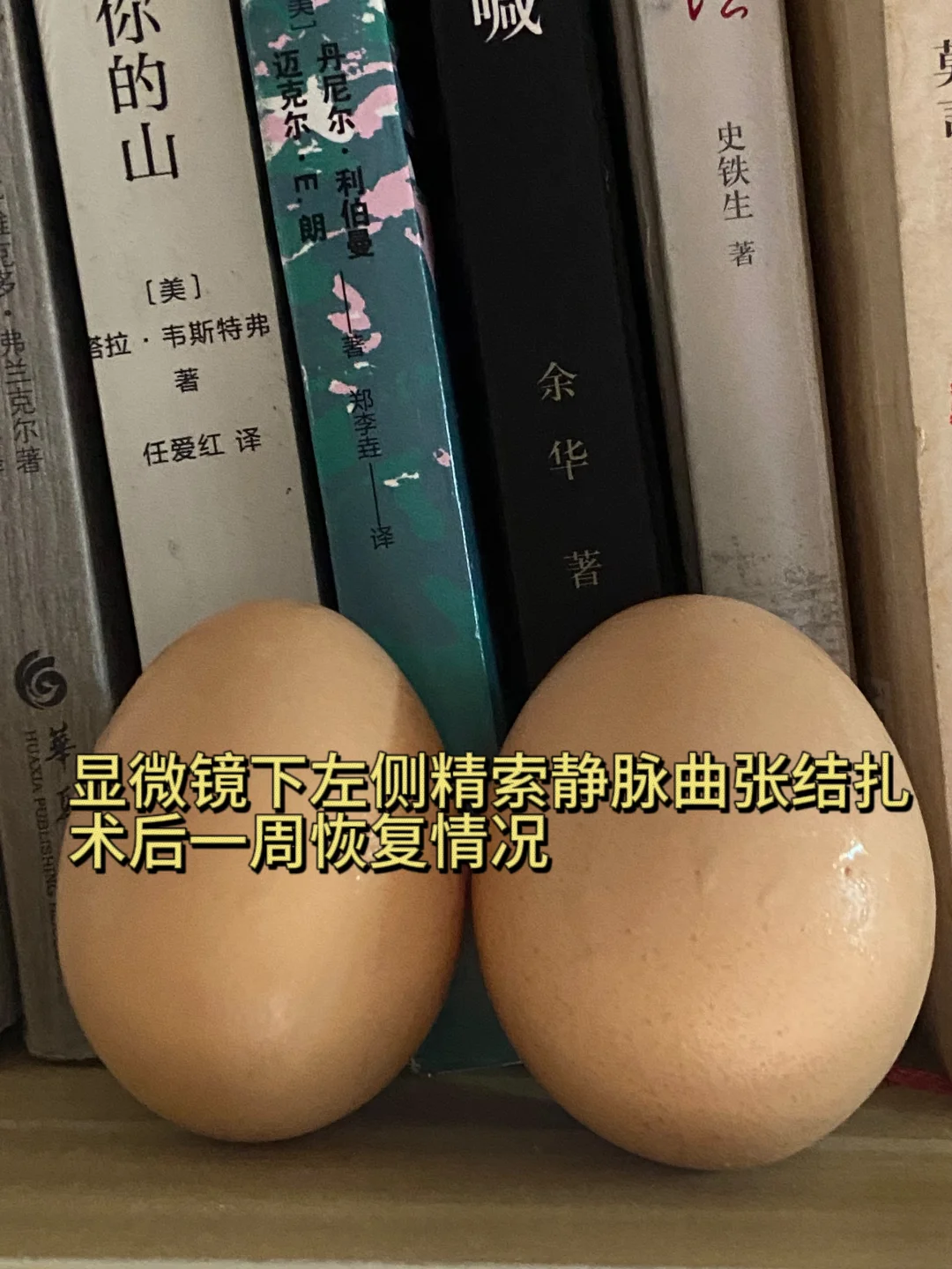 显微镜下左侧精索静脉曲张结扎术一周后…,试管代生成功率